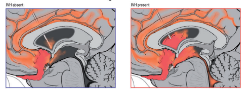 J CEREBR BLOOD F M：脑脊液血红蛋白促进蛛网膜下腔出血相关的继发性<font color="red">脑损伤</font>