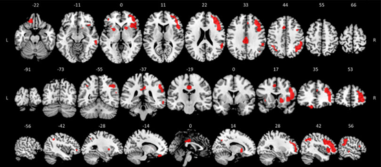 NeuroImage：研究工作记忆任务诱发的神经激活的新方法：PET/fMRI同步研究