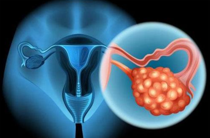 Br J Cancer：他汀类药物的使用与卵巢癌患者存活率的关联性研究