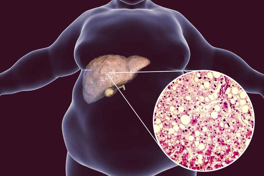 <font color="red">柳叶刀</font>子刊重磅发现，脂肪肝可导致多系统疾病