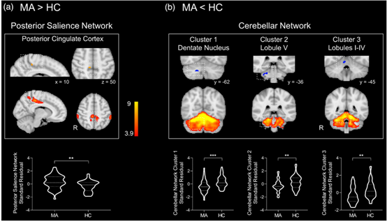 Hum Brain <font color="red">Mapp</font>：rACC可能是甲基苯丙胺男性滥用者戒断时间和情感症状严重程度之间联系的神经基础