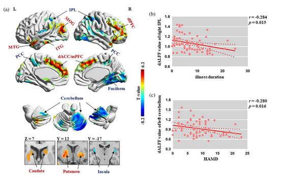 Human brain mapping：未用药强迫症患者局部脑神经活动的时间<font color="red">变异</font>性