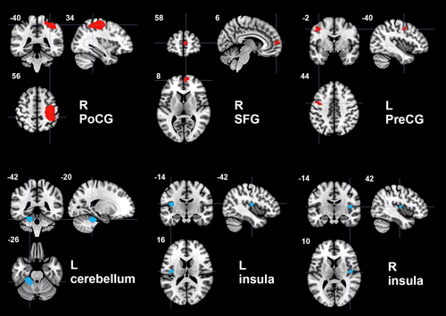 Hum Brain Mapp: 特发性震颤患者的脑活动改变不仅存在于<font color="red">小脑</font>和大脑皮层运动区，也存在于某些非运动区
