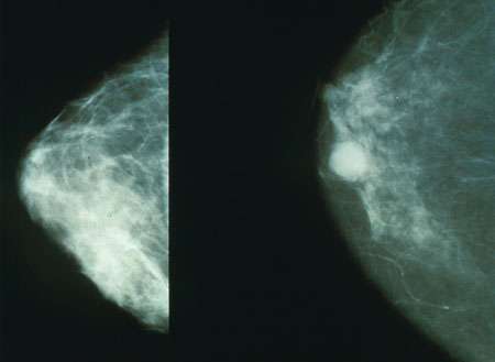 Nat Cancer：确定常见乳腺癌对治疗产生耐药性经过