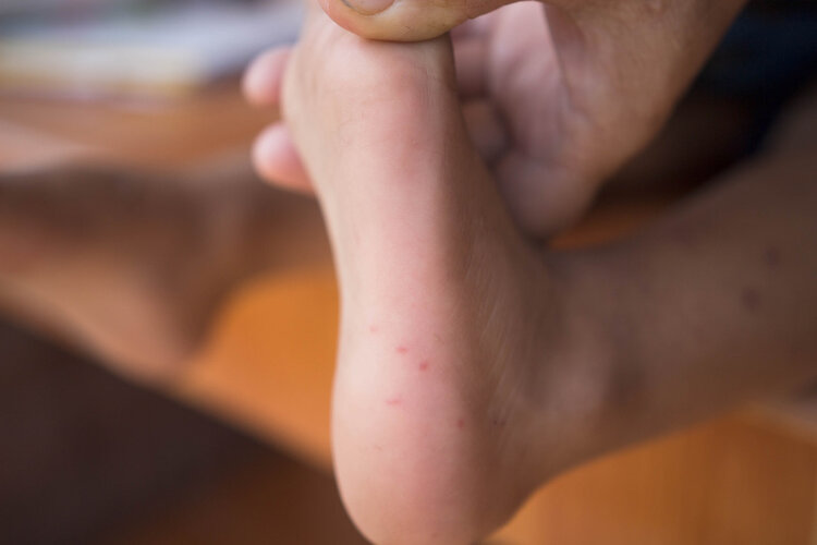孩子发烧长疹子是得了手足口吗？也可能是这两种病