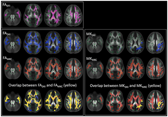 NeuroImage:MK-Curve提高了识别临床精神病<font color="red">高危</font>患者白质改变的敏感性