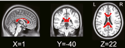 NeuroImage:人类胼胝体与白质<font color="red">功能</font>网络的结构和<font color="red">功能</font><font color="red">连接</font>映射