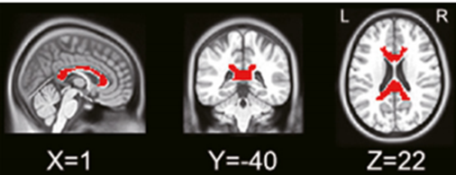 NeuroImage:人类胼胝体与白质功能网络的结构和功能连接<font color="red">映射</font>