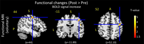 NeuroImage:视觉运动学习中行为表现的改善与大脑功能和微观结构的改变相关