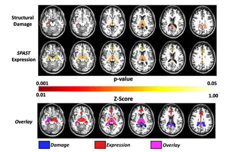 Mov Disord:遗传性痉挛性截瘫亚型脑损伤的病理<font color="red">生理机制</font>不同