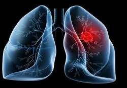 Lung Cancer：布加替尼（brigatinib）治疗既往治疗过的ALK+转移性非小细胞肺癌患者的疗效：真实世界研究
