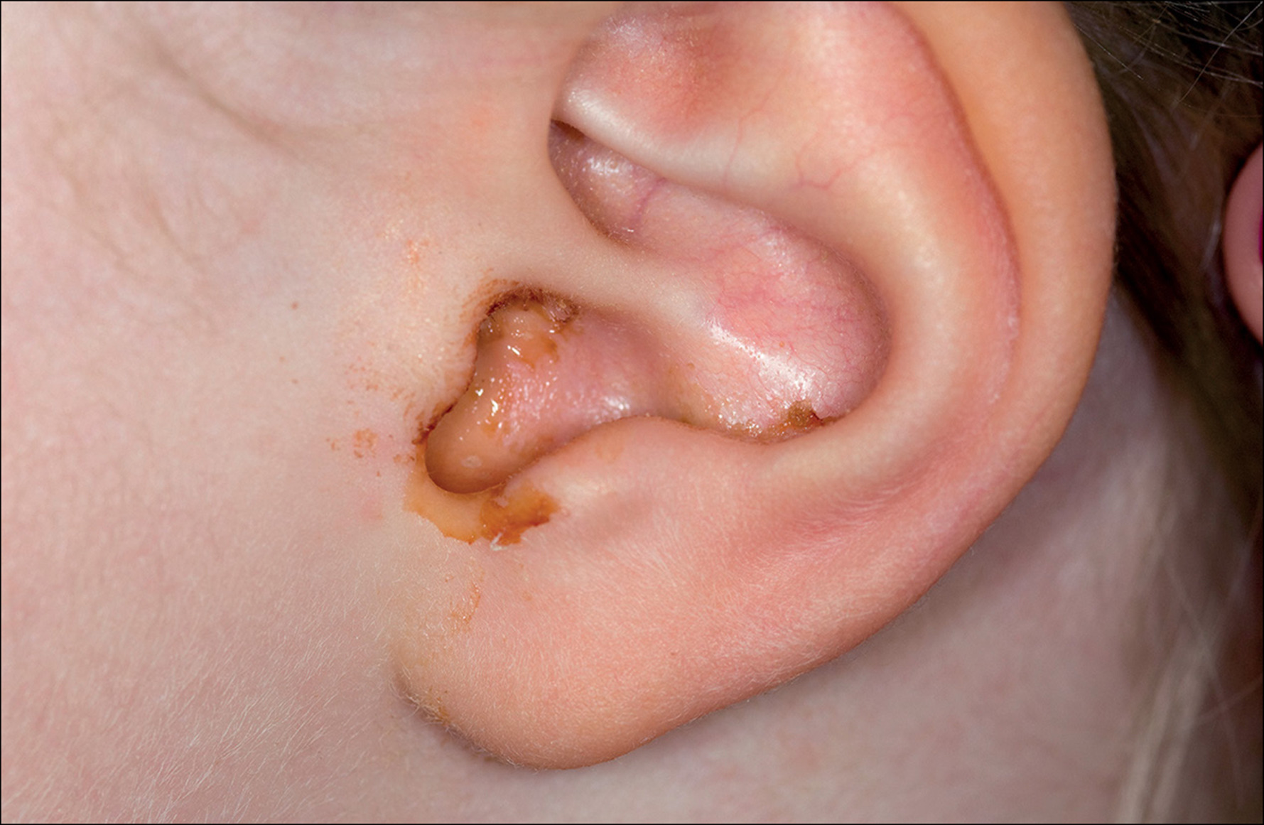npj biofilms and microbiomes ： 研究人员开发出一种治疗中耳炎的新技术