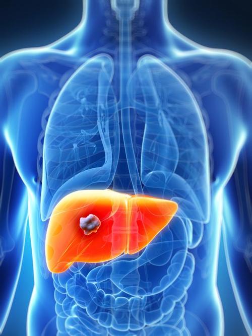 J Hepatology：索拉非尼能降低<font color="red">肝细胞</font>癌的肿瘤生长速度降低和肝功能的恶化