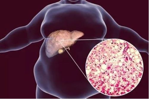 GUT：累及1/4人口，脂肪肝患者晚期纤维化如何提高诊断准确性？