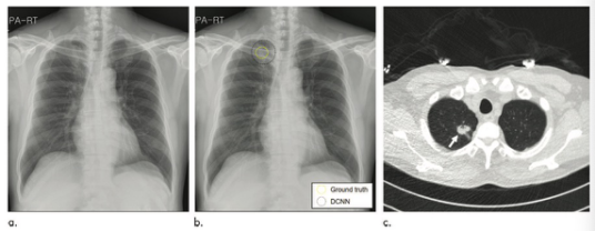 Radiology：你还在为胸部X线片上的胸部X线片烦恼吗？