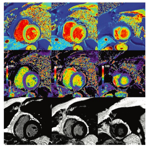 Radiology：MRI T1 mapping在肥厚型心肌病中的应用