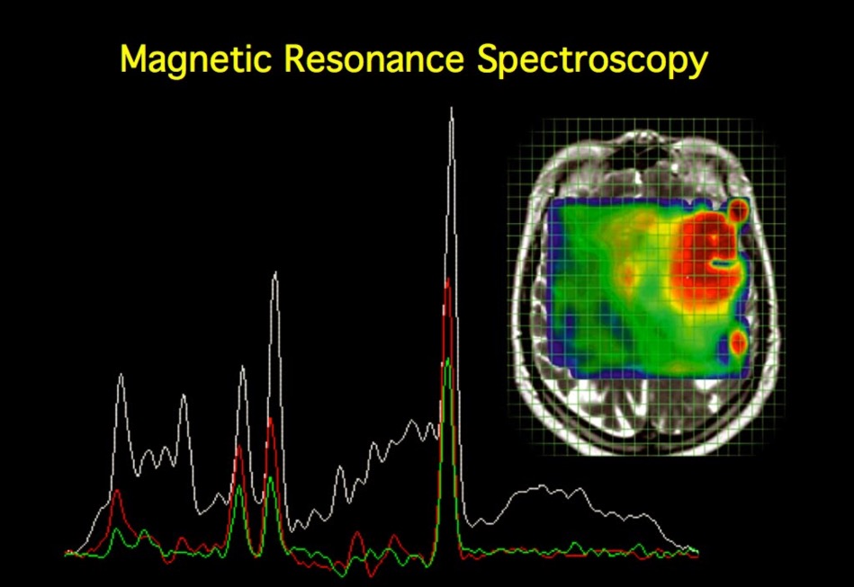 ASCO-2021速递：<font color="red">光谱</font>MRI可指导胶质母细胞瘤放疗，安全有效