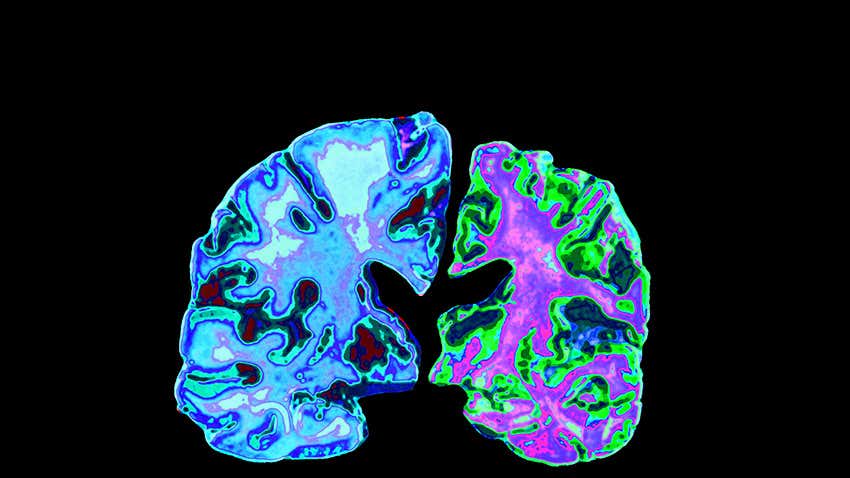 Brain：这组血浆标志物或许能预测未来脑<font color="red">萎缩</font>和痴呆