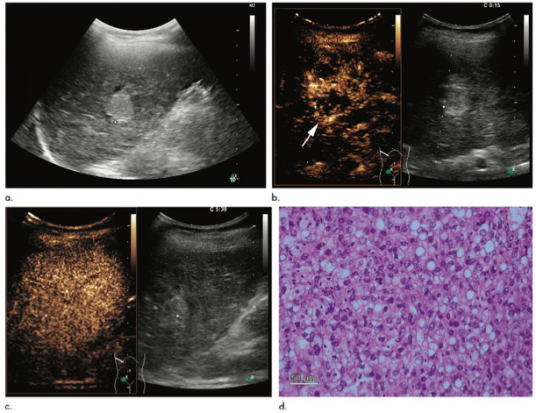 Radiology：CEUS LI-RADS对肝内小结节的诊断准确性