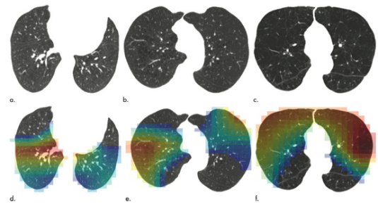 Radiology：深度<font color="red">学习</font>，使肺气肿CT模式的自动分类成为可能
