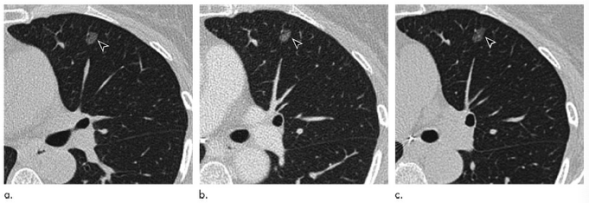 Radiology：肺结节已经5年没有变化了，还需要继续随访吗？