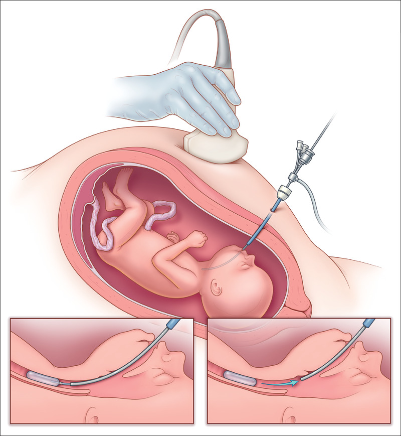 NEJM：严重左侧膈疝胎儿手术的随机试验