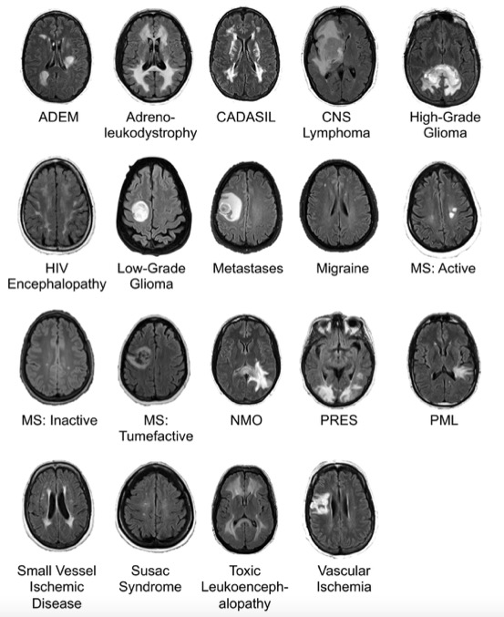 人工智能在颅脑<font color="red">MRI</font>上的鉴别诊断 