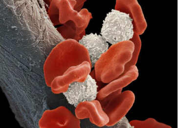 Leukemia：艾曲波帕eltrombopag在<font color="red">骨髓</font><font color="red">增生</font><font color="red">异常</font><font color="red">综合征</font>的PDX模型中的临床前评估