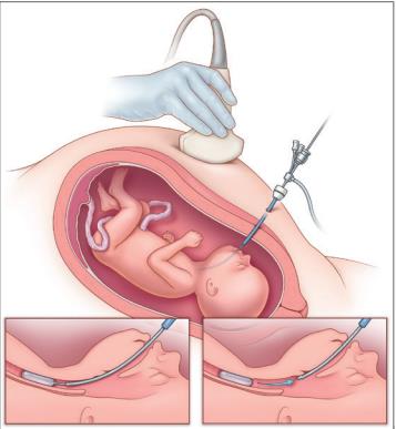 NEJM：胎儿镜下气管球囊阻塞术可提高严重先天性膈疝胎儿存活率