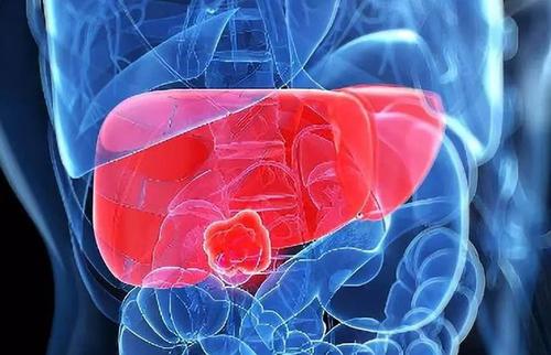 AP&T: 慢性乙型肝炎抗病毒治疗患者中心性肥胖与肝细胞癌的关系