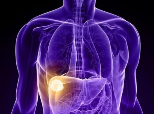 J Gastroenterology H：肌肉体积在乐伐替尼治疗肝细胞癌中的临床重要性