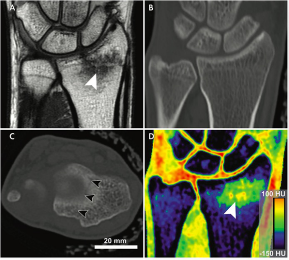 Radiology:双能CT在腕关节损伤的中附加价值