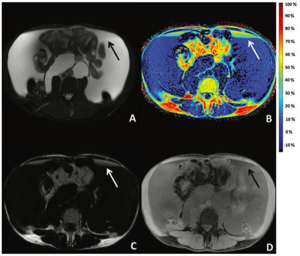Radiology：MRI Dixon<font color="red">脂肪</font>定量技术在乳糜液中的应用