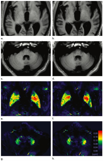 Radiology：钆对比剂的使用究竟会在脑组织中产生何种影响？QSM有话说。