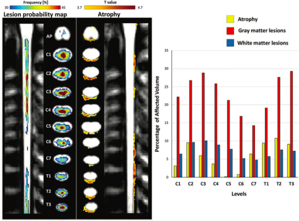 Radiology：视神经脊髓炎谱系疾病的新角度：从影像走向临床