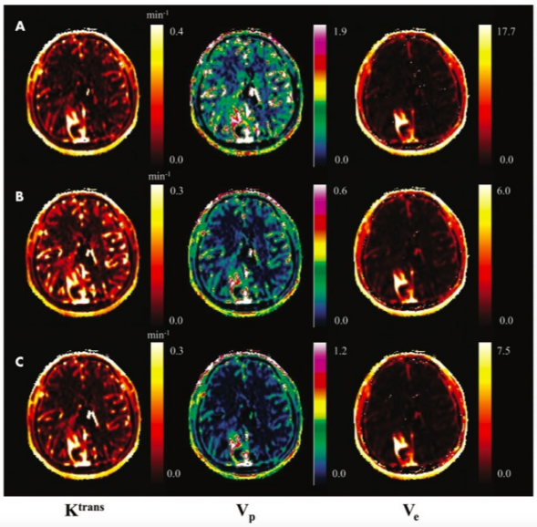 Radiology：人工智能在星形细胞瘤DCE MRI<font color="red">药</font><font color="red">代</font><font color="red">动力学</font><font color="red">参数</font>中的应用