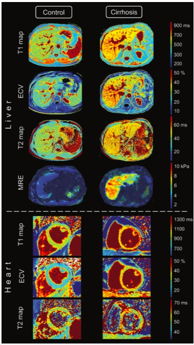 Radiology：从影像学的角度解读肝<font color="red">硬化性</font>心肌病