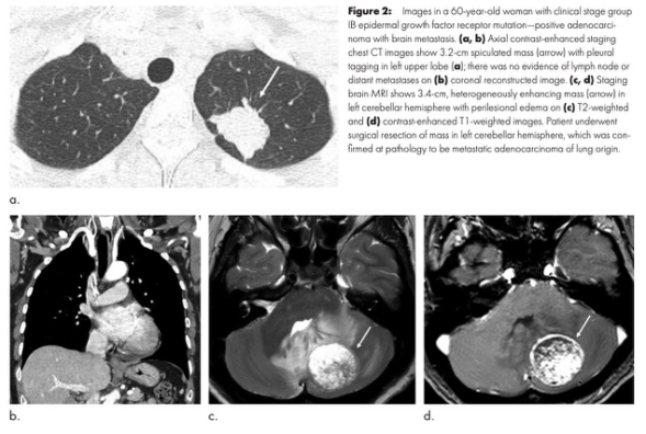 Radiology：对于非小细胞肺癌患者来说，仅行CT检查还远远不够