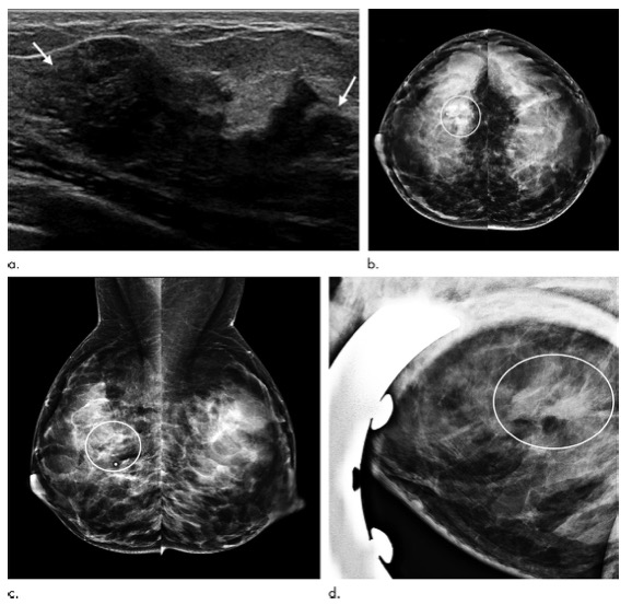 Radiology：哺乳期女性若发现可触及的乳房肿块该怎么办？