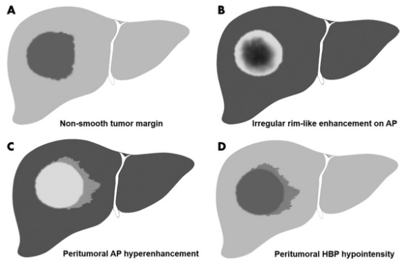 Radiology：在预测HCC微血管浸润方面，MR并非想象中的可靠！
