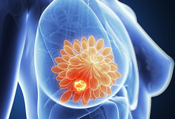 Clin Cancer Res：尼拉帕利在<font color="red">携带</font>BRCA1/2胚系突变的晚期乳腺癌中的治疗活性