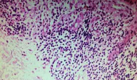 JEADV：根据基线血液肿瘤负荷评估Mogamulizumab在蕈样真菌病<font color="red">或</font>Sézary综合<font color="red">征</font>中的疗效