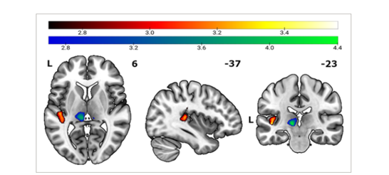 HUMAN BRAIN MAPPING:你的<font color="red">痛</font><font color="red">点</font>有多高，岛叶皮质来决定
