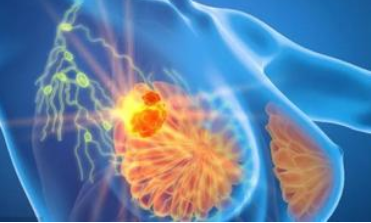 Eur J Cancer：拉帕替尼和曲妥珠单抗同步治疗HER2+乳腺癌可的预后