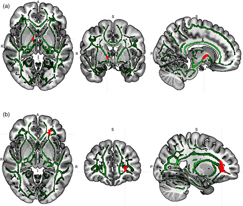 HUMAN BRAIN MAPPING：重度抑郁症患者<font color="red">神经质</font>、快感缺乏等症状与特定白质连接有关