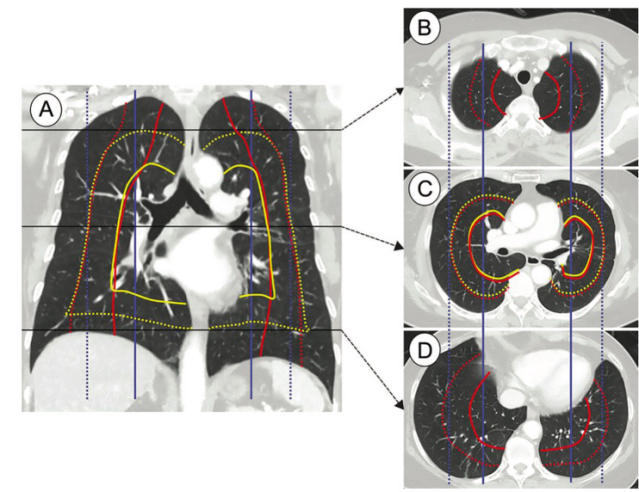 <font color="red">Radiology</font>：中央型肺癌的新定义？