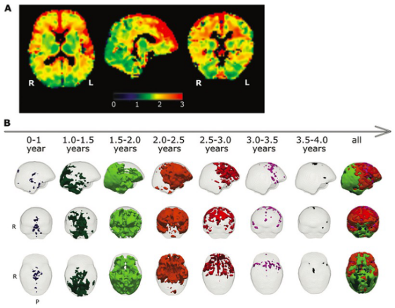Radiology：从<font color="red">ADC</font>值走进大脑发育的进程！