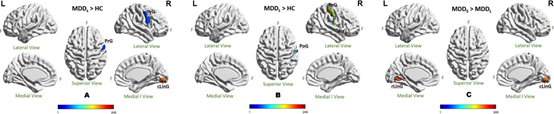 HUMAN BRAIN MAPPING: <font color="red">疾病</font>的持续时间影响MDD<font color="red">网络</font>模式