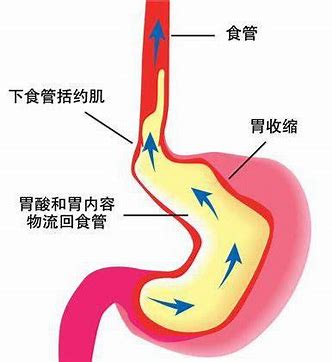 J Clincal Gastroenterology：就餐与<font color="red">就寝时间</font>过短是妊娠妇女胃食管反流病的主要危险因素