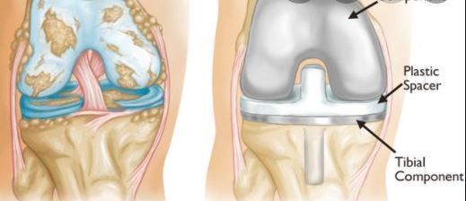 PLOS MED：肥胖会导致膝关节置换术患者“二次手术”，但却降低死亡率！